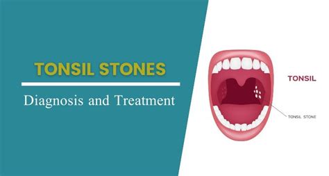 Tonsil Stones: Causes, symptoms, and treatment | Behindeye.com