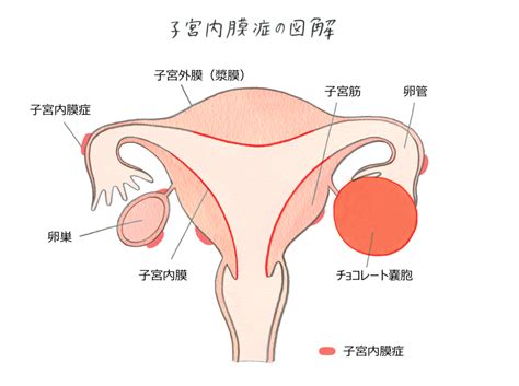 子宮内膜症 不妊治療オンライン