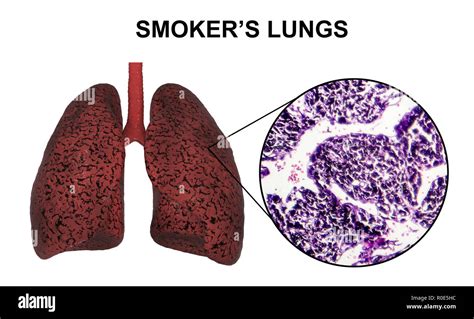 Lungs anatomy smoker hi-res stock photography and images - Alamy