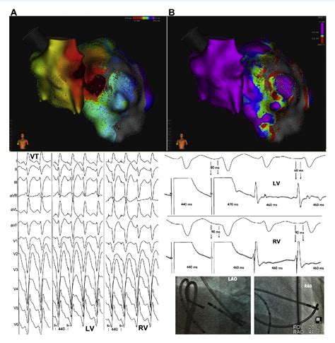 Figure From High Density Biventricular Activation Mapping During