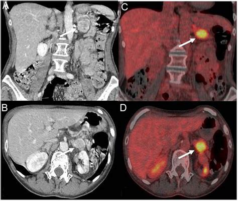 Contrast Enhanced Abdominal Computed Tomography Showing A 3 Cm Left