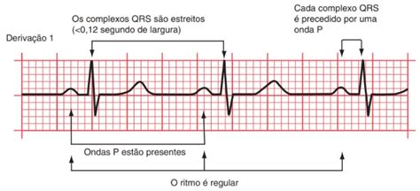 O Que Eletrocardiograma Como Realizar A Leitura