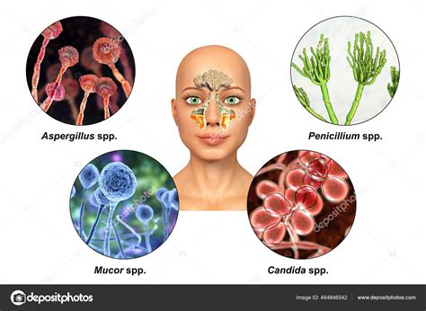 อราเป นสาเหต ของไซน กเสบ ภาพ แสดงการอ กเสบของไซน สและเช อรา Aspergillus