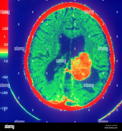 Tomografía axial computarizada del cerebro muestra Tumor Fotografía de