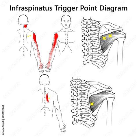 Infraspinatus Trigger Point Diagram Stock Vector Adobe Stock