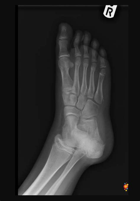 View 15 Broken Little Toe Xray - inimagemention