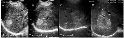 Ultrasonic Imaging In Liver Disease From Bench To Bedside IntechOpen