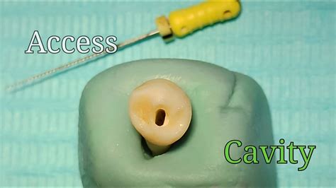 Access Cavity Preparation Mandibular First Premolar Youtube