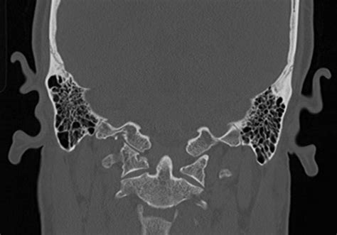 File:Petrous bone trauma - fracture, ossicular dislocation and ...