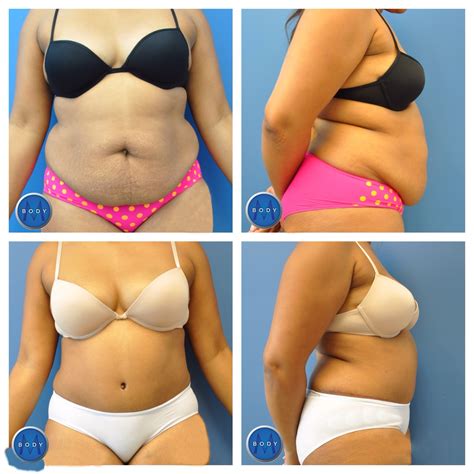 Tummy Tuck Northern Virginia Vienna Washington Dc