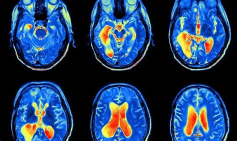 Hebrew U's new MRI can 'see' molecular changes in the brain ...