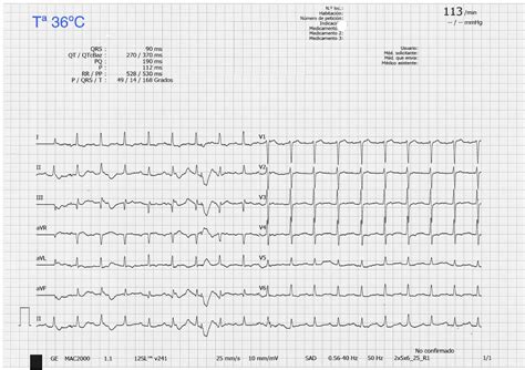 Evolution of Osborn’s J-wave in severe hypothermia | Medicina Intensiva