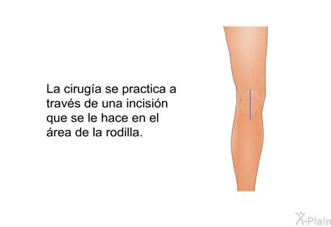 Patedu Reemplazo De Rodilla C Mo Prevenir Complicaciones