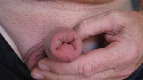 Swollen Cock After Nettles Treatment Oin Foreskin Gay Xhamster