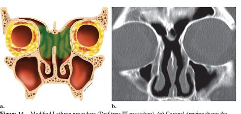 Figure From Failed Endoscopic Sinus Surgery Spectrum Of Ct Findings