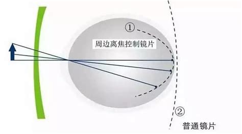 “框架版ok镜”到底是什么、热门产品该如何选择？一文带你读懂离焦镜片！ 知乎