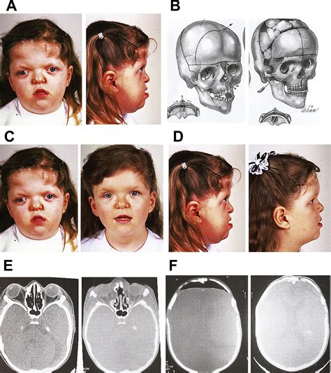 Craniofacial Dysostosis Syndromes Evaluation And Staged Reconstructive