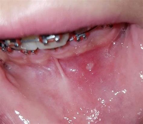 Everything You Need To Know About Recurrent Aphthous Stomatitis Canker