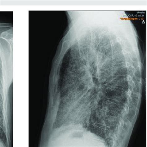 Chest X Ray At Initial Presentation Anteroposterior A And Lateral