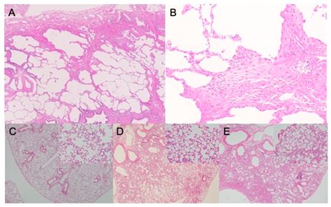 Pulmonary Fibrosis Histology