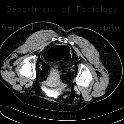 Radiology Case Flat Lesion Colorectal Carcinoma Sigmoid Colon Ctc