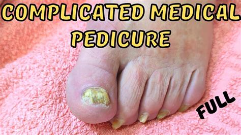 Complicated Medical Pedicure Fungus Ingrown Toenails Ram S Horn