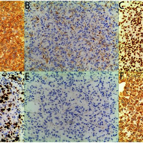 Immunohistochemical Staining The Tumor Showed Diffuse Immunoreactivity