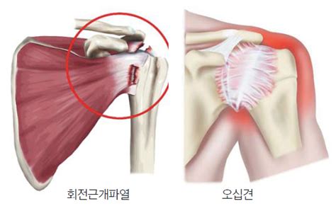 중년 어깨 통증은 오십견 회전근개파열도 염두를 국민일보