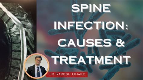 Spine Infection Causes And Treatment Youtube