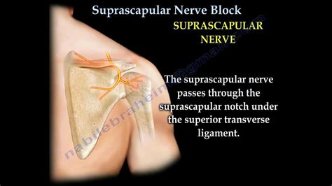 Shoulder Pain Injection Suprascapular Nerve Block Everything You Need