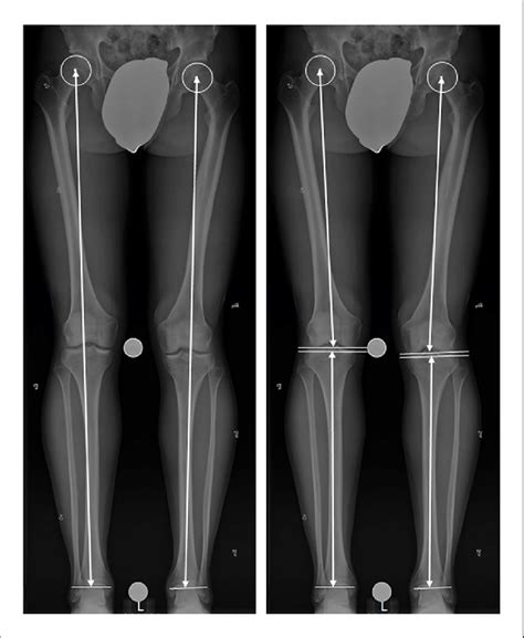 Illustration of measurement of limb length (left) and length of femur ...