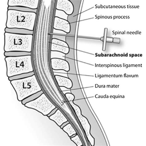 Lumbar Puncture Drawing Courtesy Of Todd Cooper Download Scientific