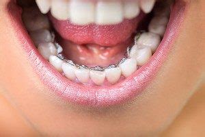 Types of Retainers | Schmitt Orthodontics | Henderson NC