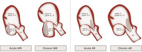 NephroPOCUS On Twitter Simple Yet Informative Illustration