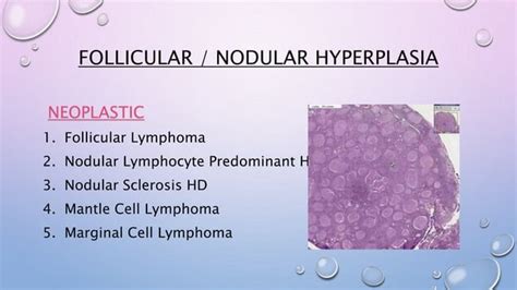 Patterns Of Lymph Node Hyperplasia Ppt