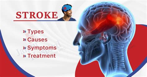 Stroke Types Causes Symptoms And Treatment Jaipur Hospital