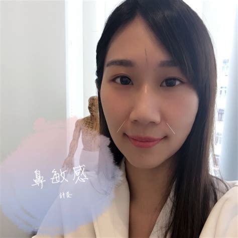 健康資訊】鼻敏感應叫香港鼻？ 女中醫推介天灸ko鼻敏感！ Health Concept