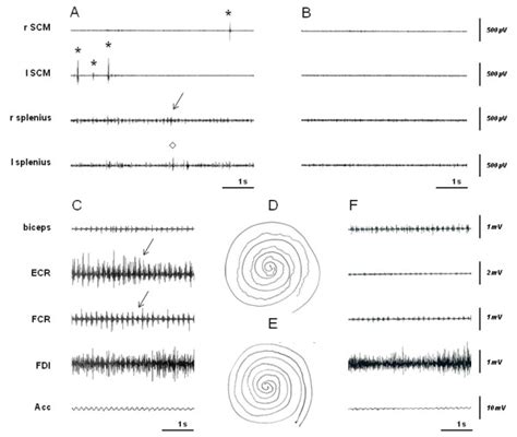 Polymyographic Recordings Of Tremor And Myoclonus In Two Patients With