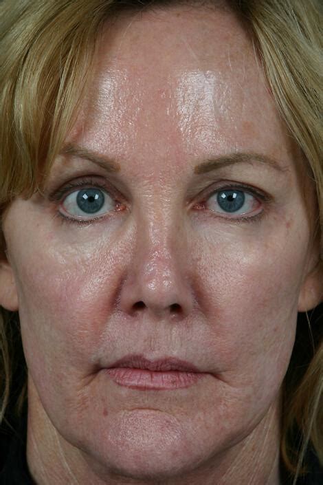 Injectable Fillers Gallery Before After Patient Marina Medspa