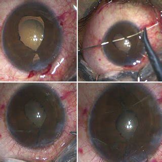 Posterior Chamber Phakic Intraocular Lens Scaffold Pupilloplasty A