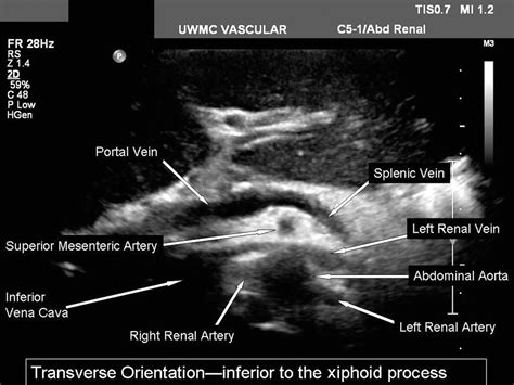 Renal Artery Anatomy Ultrasound