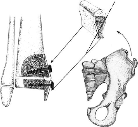 Drawing To Show The Preparation Of The Non Vascularised Graft Of The Download Scientific