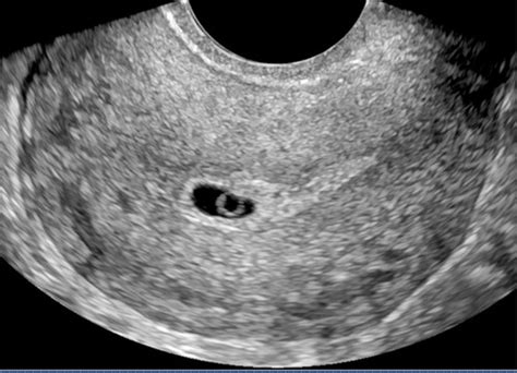 Early stage 1st Trimester Ultrasound images Flashcards | Quizlet