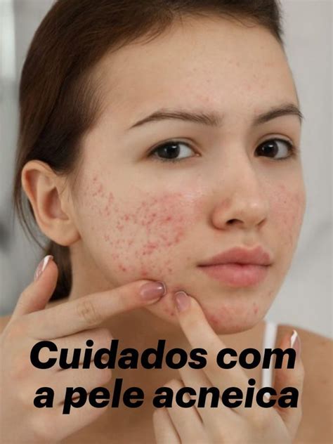 Pele Acneica Como Prevenir A Acne E Cuidar Desse Tipo De Pele Adcos