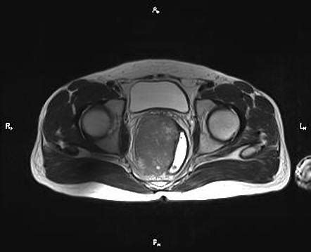 Rectal Gastrointestinal Stromal Tumor Image Radiopaedia Org