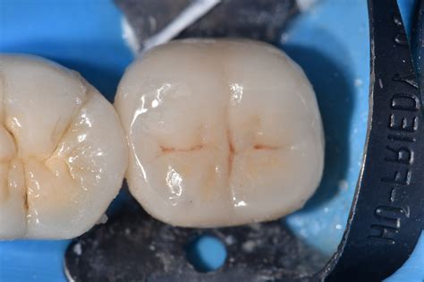 Preserving Tooth Structure in a Crown Preparation Design