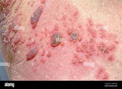 A Closeup View Of Human Skin That Has The Building Pustules Of A