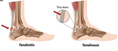 Achilles Tendinosis | Move Osteopathy