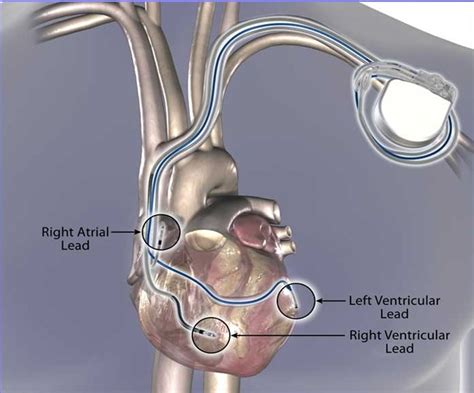 Cardiac Re Synchronisation Therapy Crt Dr Pl Saravanandr Pl Saravanan