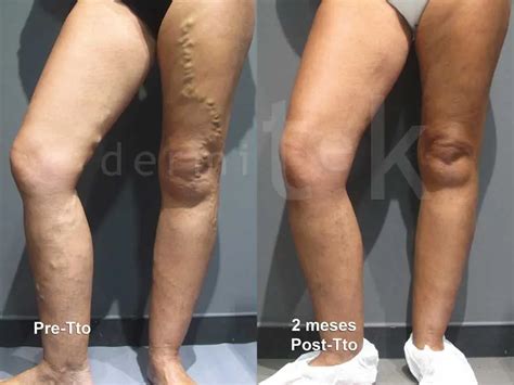 Tratamientos De Varices En Las Piernas Dermitek